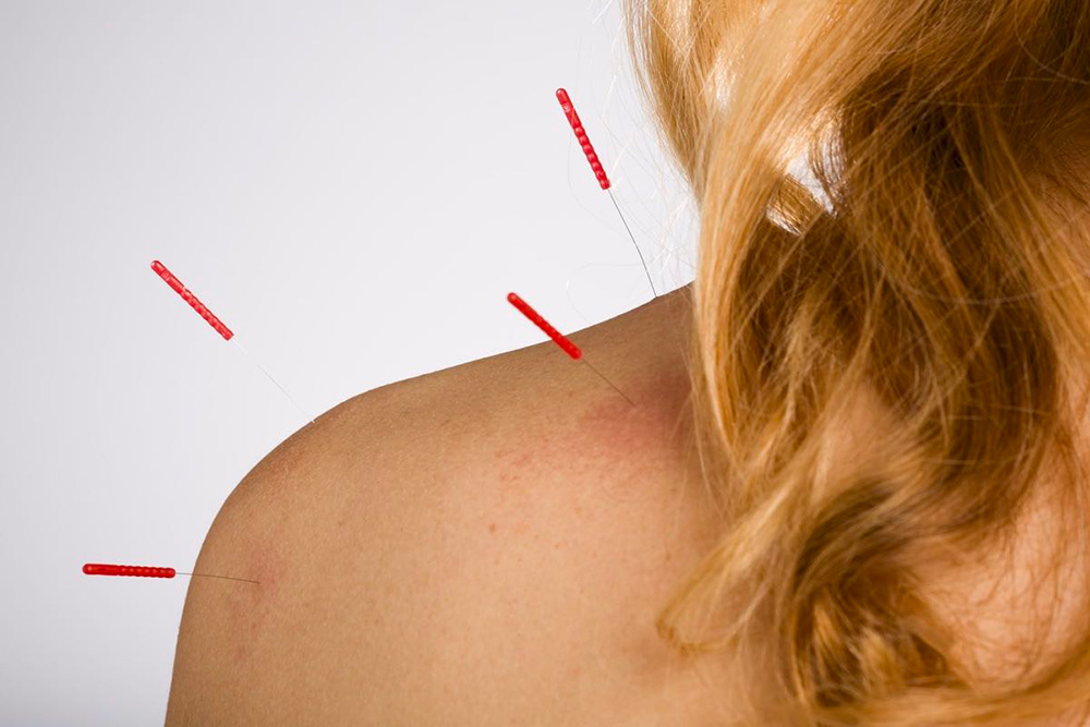 acupuncture on shoulder