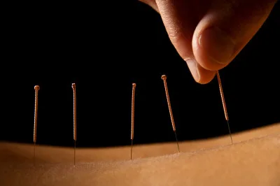Acupuncture close on back