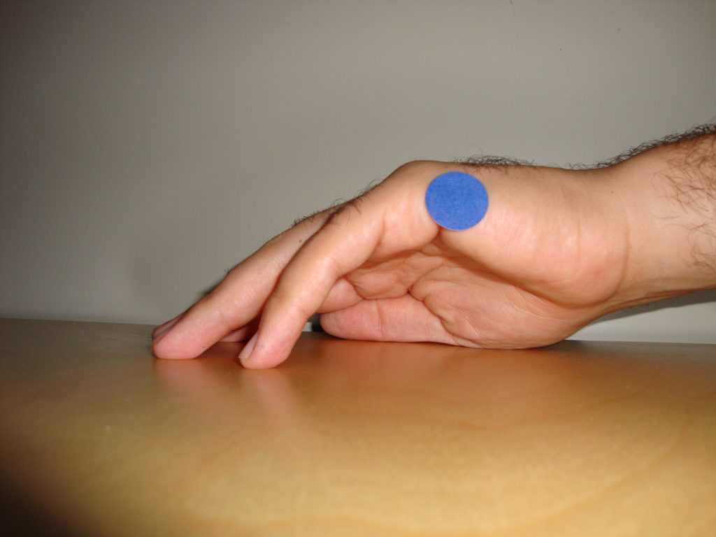 acupuncture for back pain