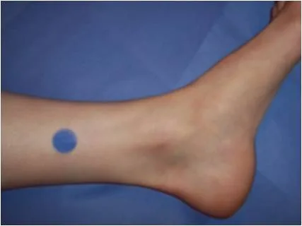 acupressure for menstrual cramps