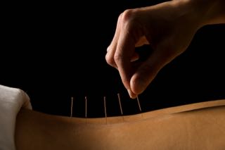 acupuncture on back 3