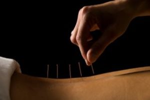acupuncture on back