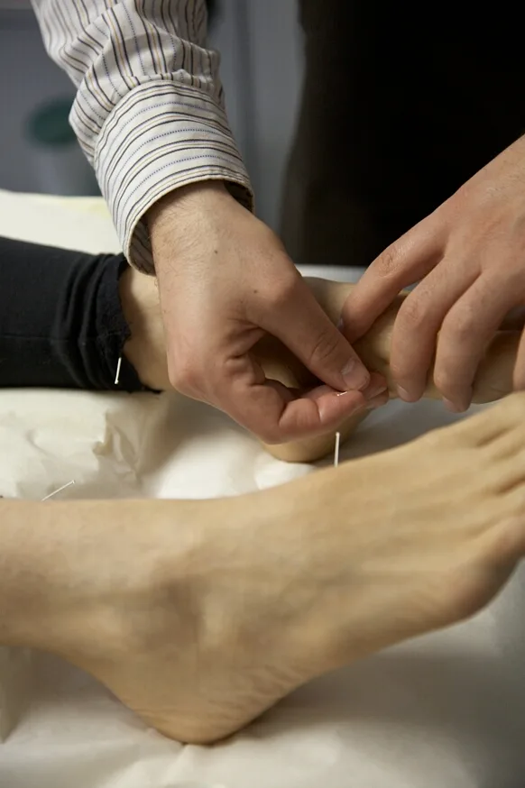 acupuncture on feet close