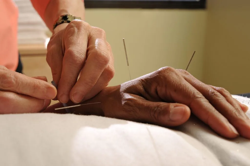 Acupuncture on hand