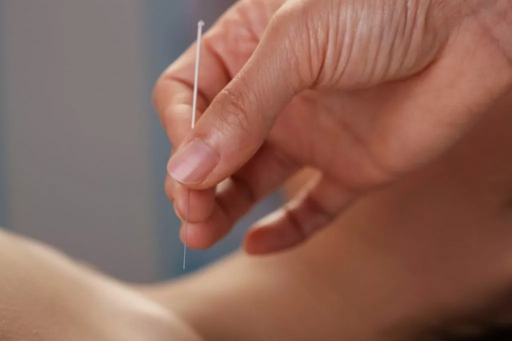 acupuncture