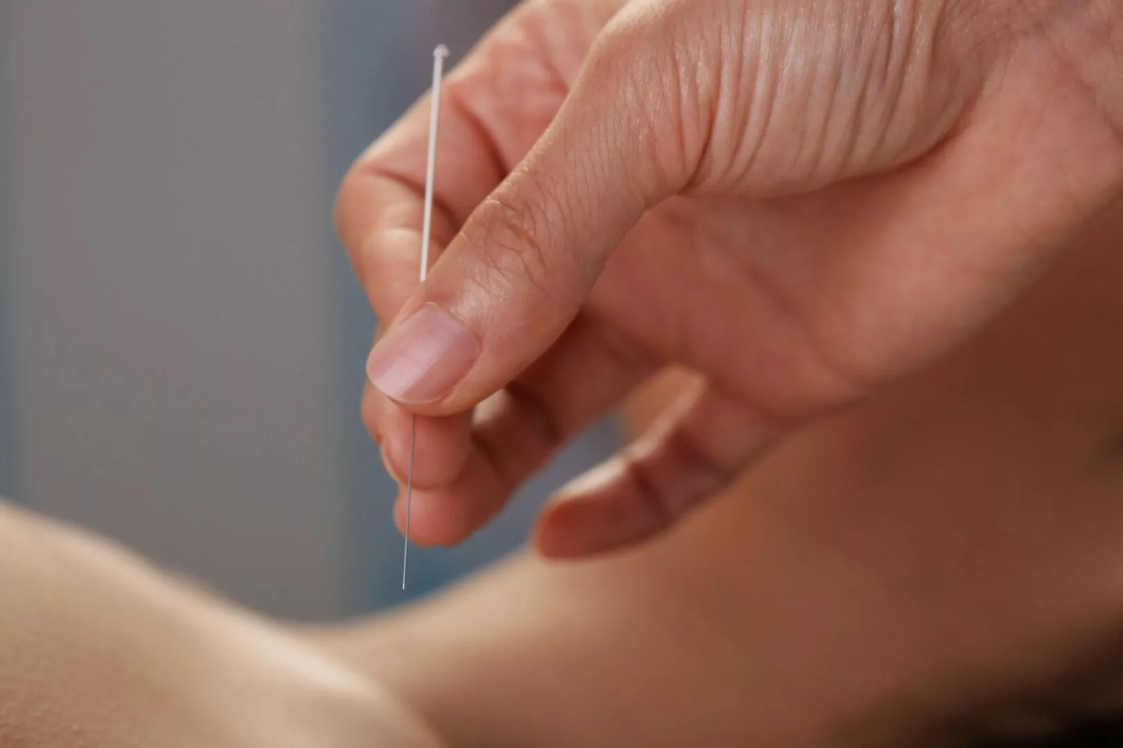 acupuncture
