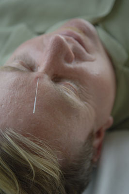 forehead needle 1