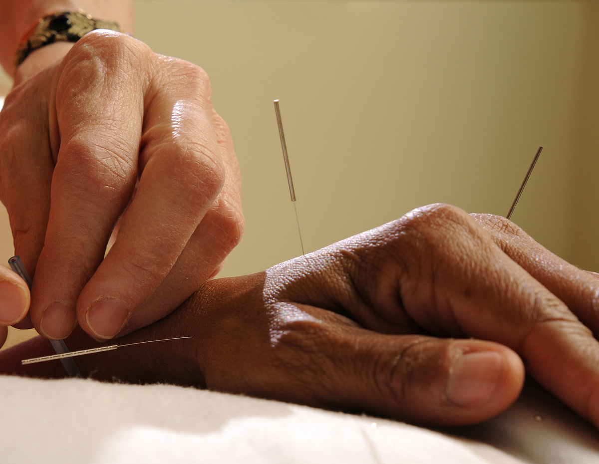 Acupuncture on hand