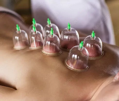 Cupping