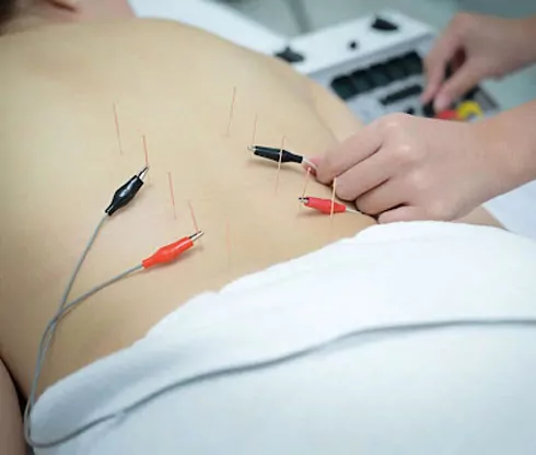 Electroacupuncture