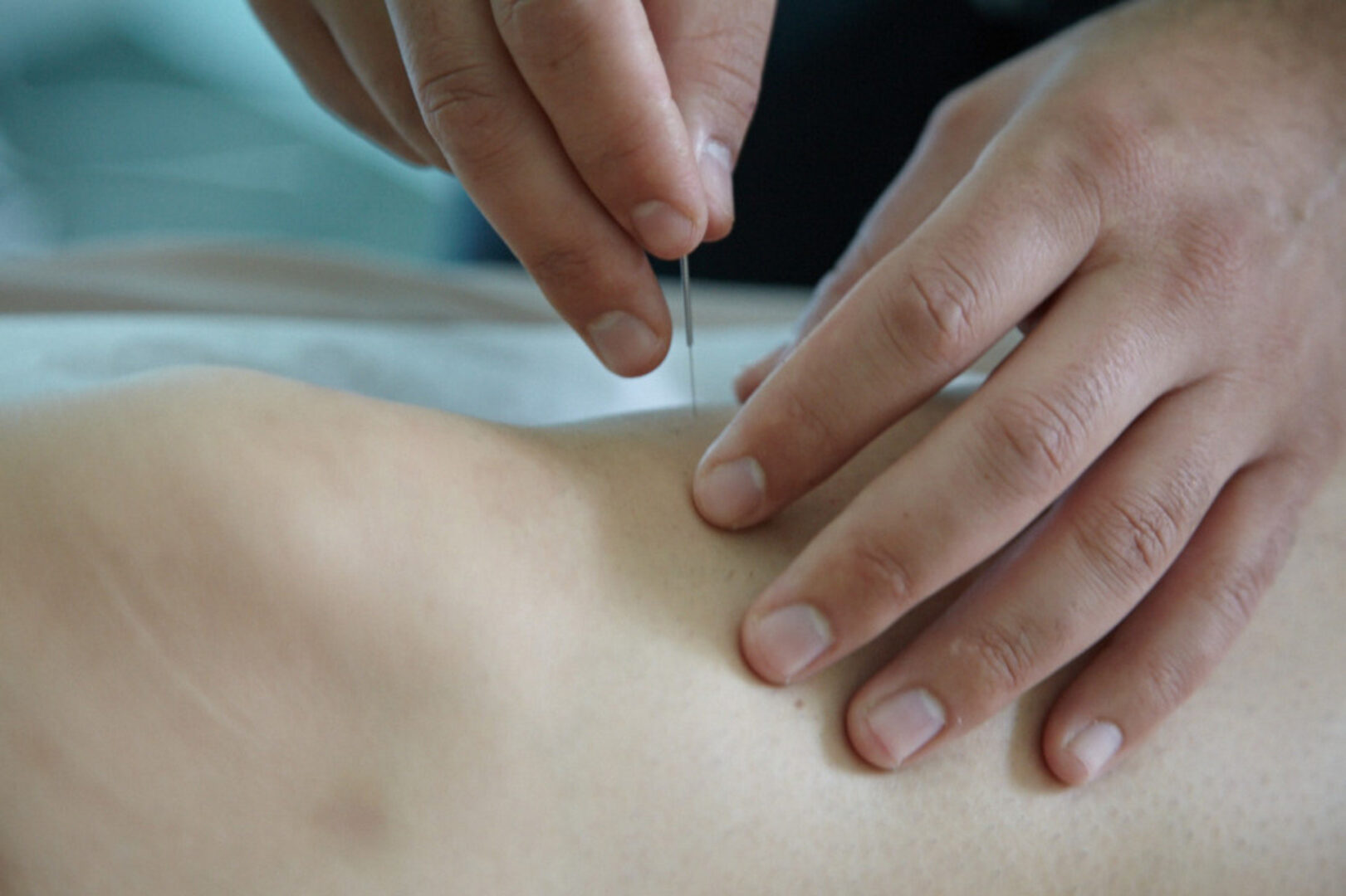 acupuncture for knee pain