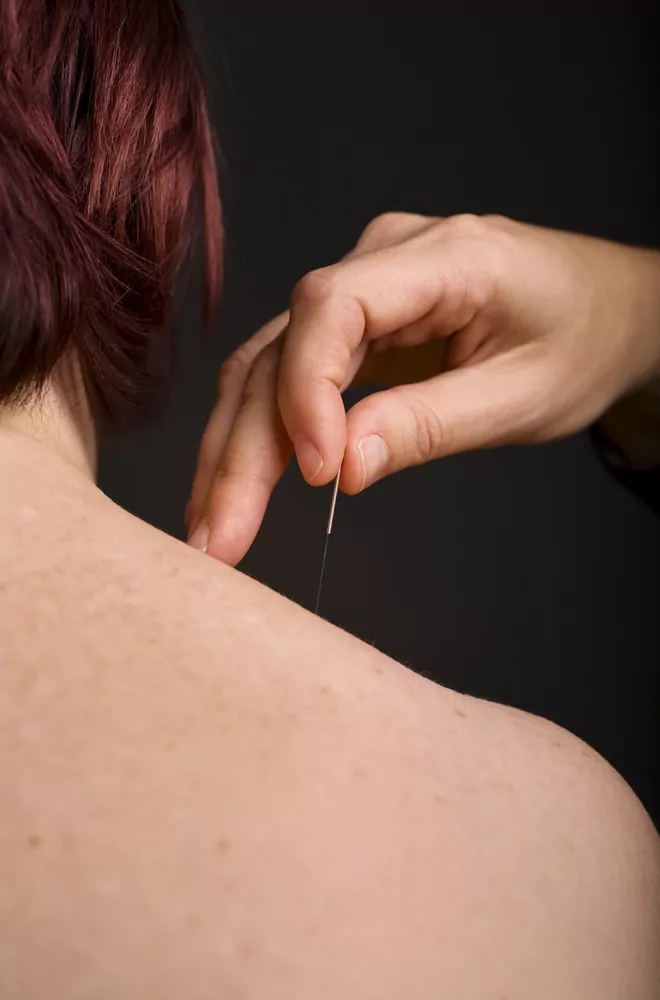 acupuncture on shoulder acupuncture on shoulder