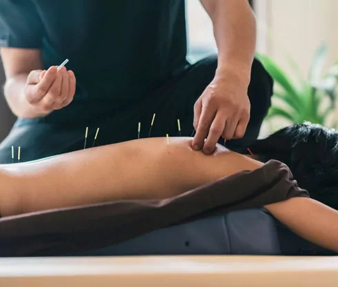 acupuncture