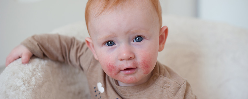 eczema