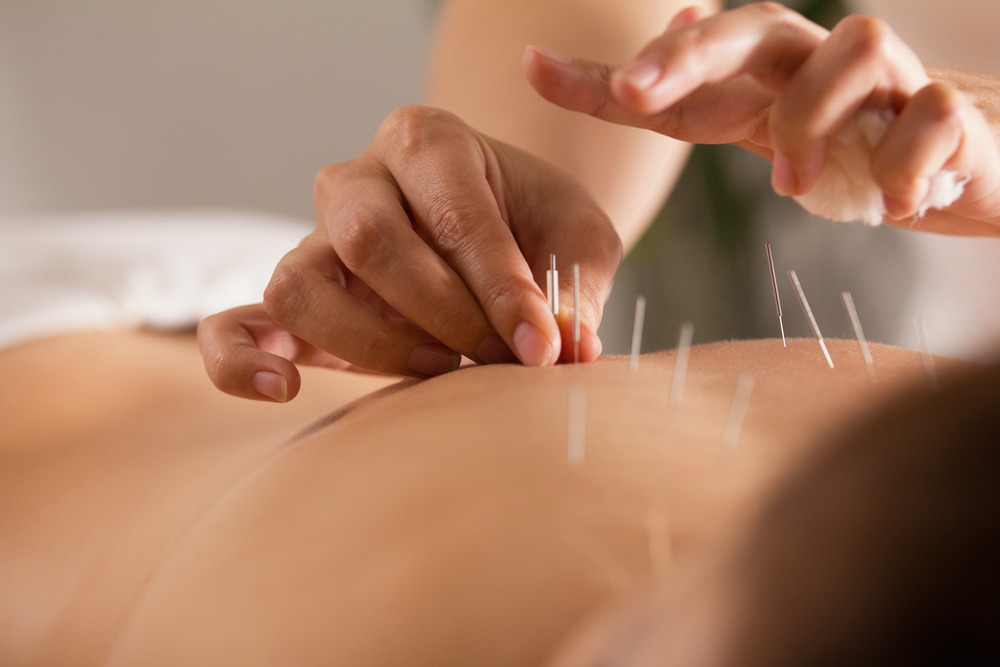 acupuncture on upper back