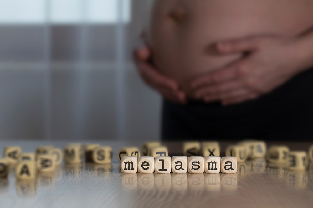 pregnant woman with melasma