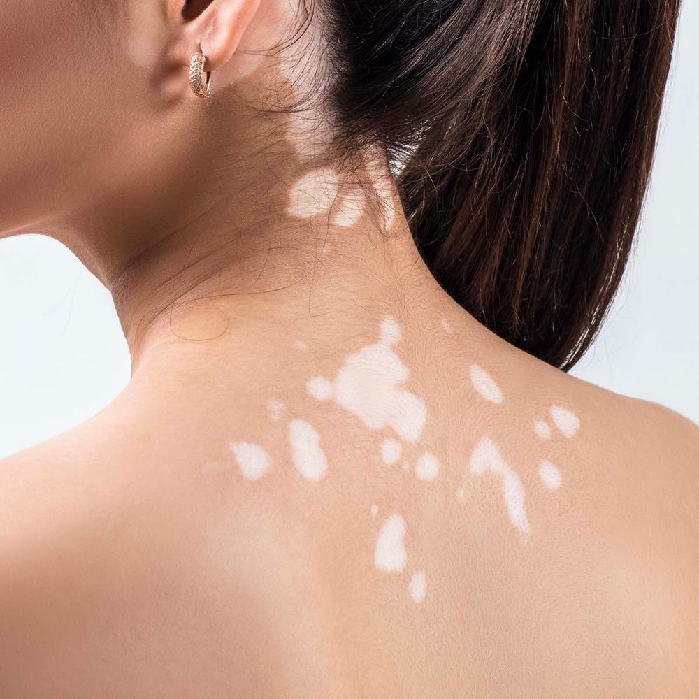 vitiligo on back