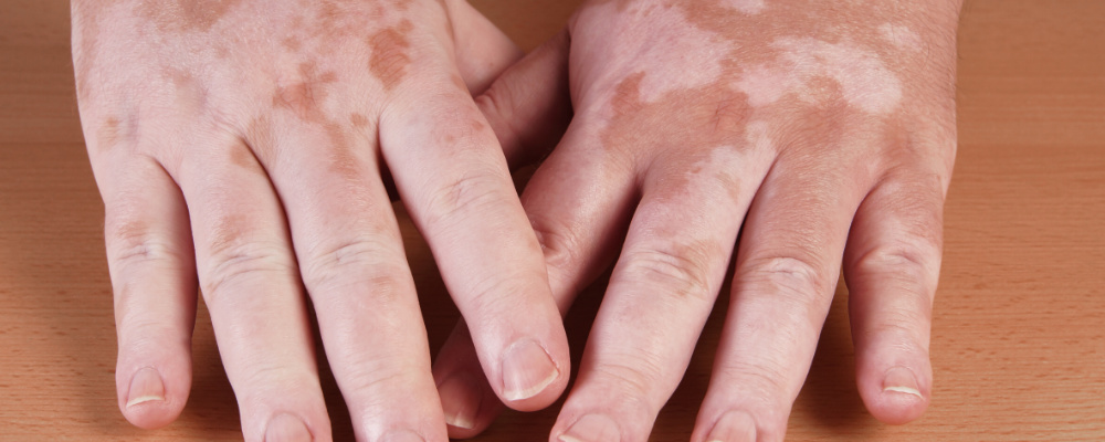 vitiligo on hands