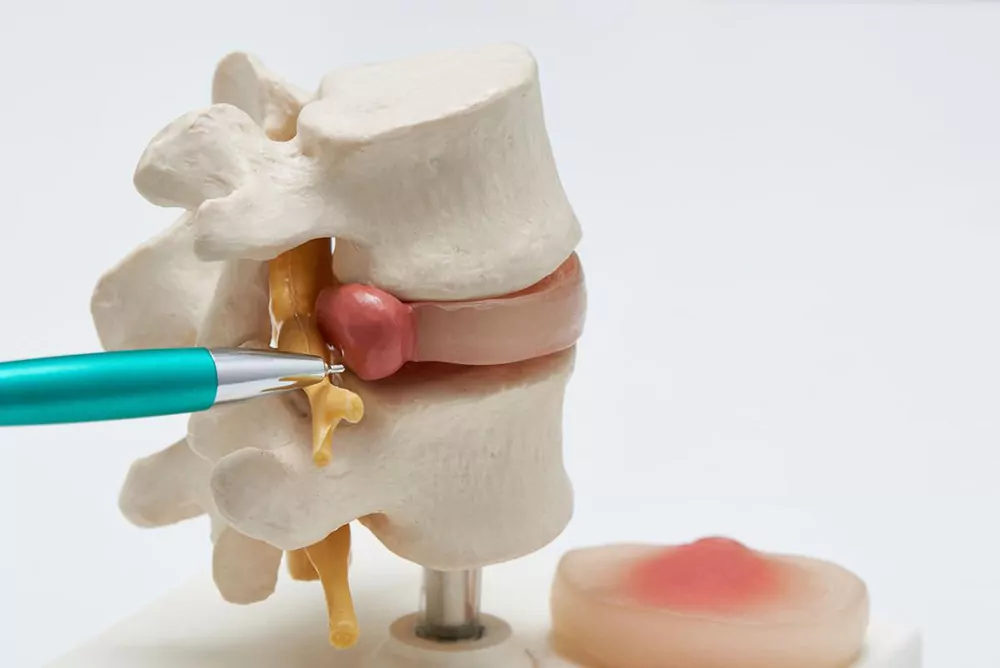 herniated disc model