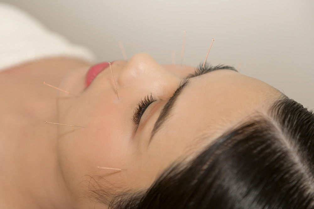 acupuncture on face
