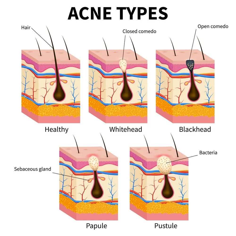 acne types