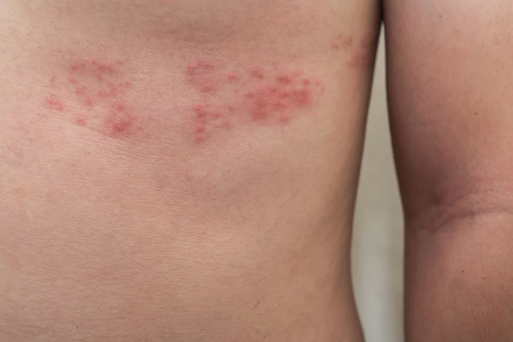 shingles on chest