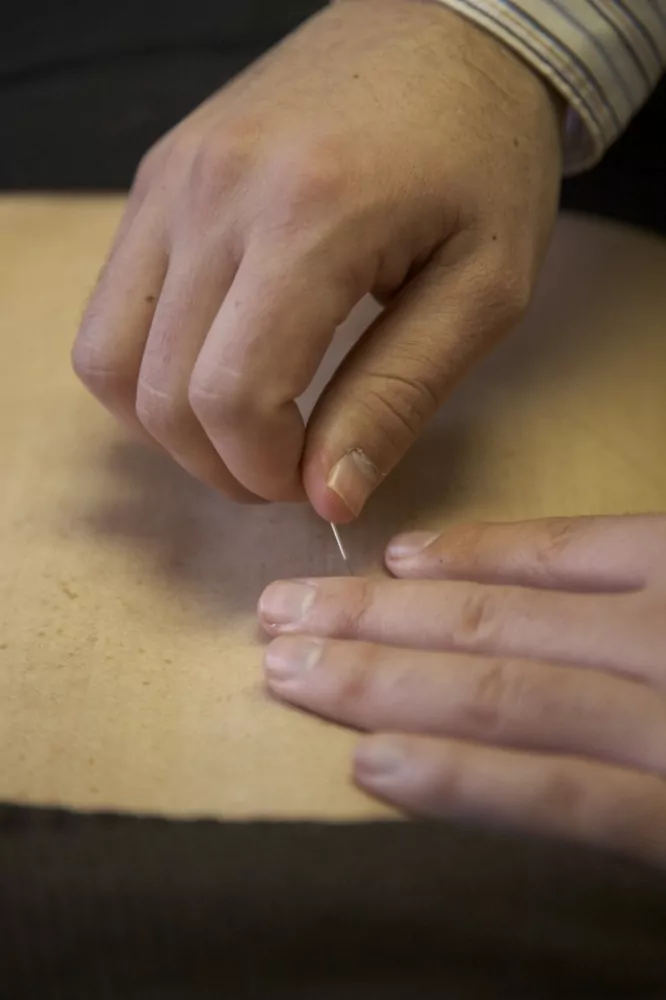 Acupuncture for sciatica