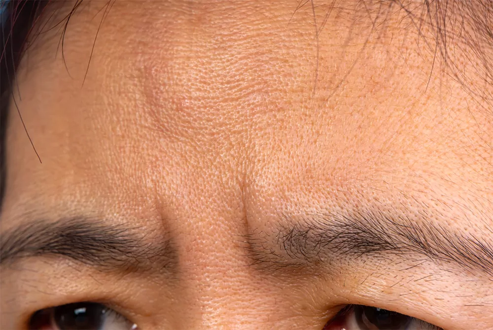 Acupuncture Reduce Frown Lines