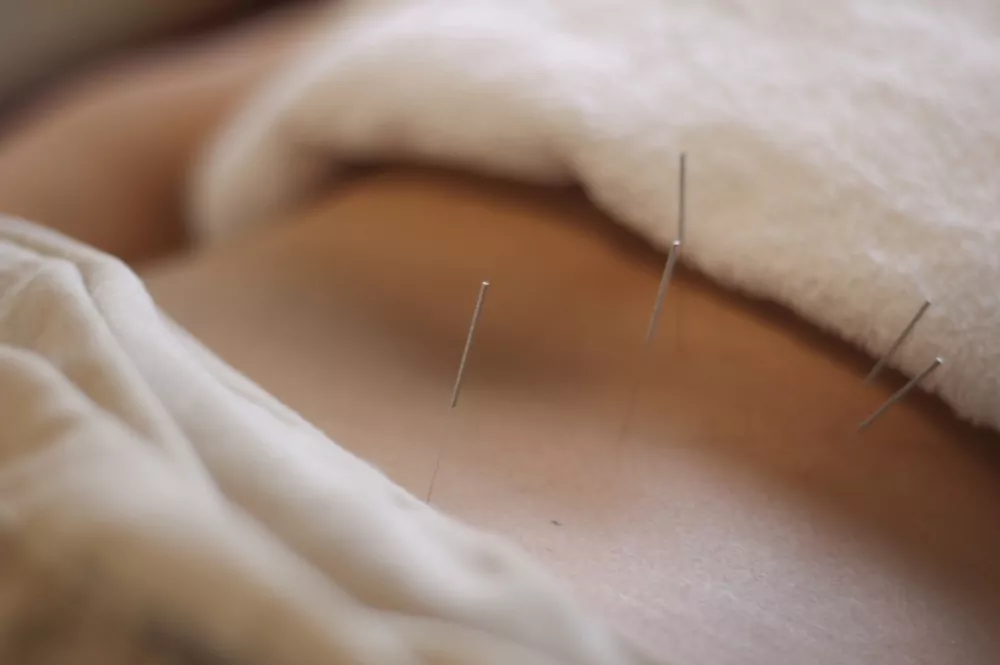 acupuncture lower back