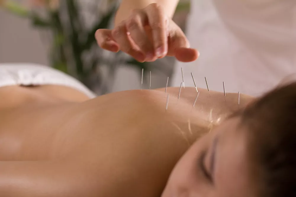 Acupuncture Back