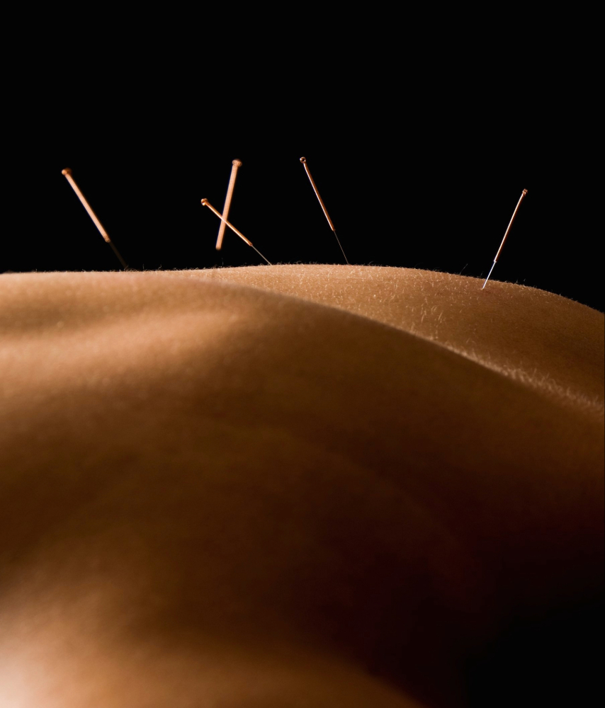 Acupuncture on back