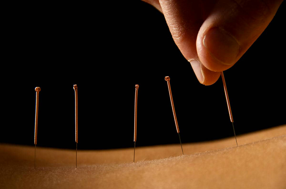 Acupuncture close on back