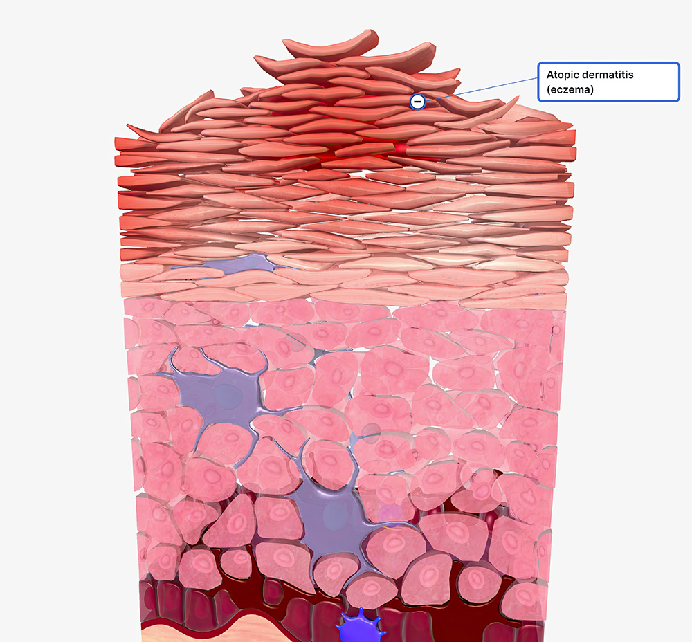 eczema cellular level
