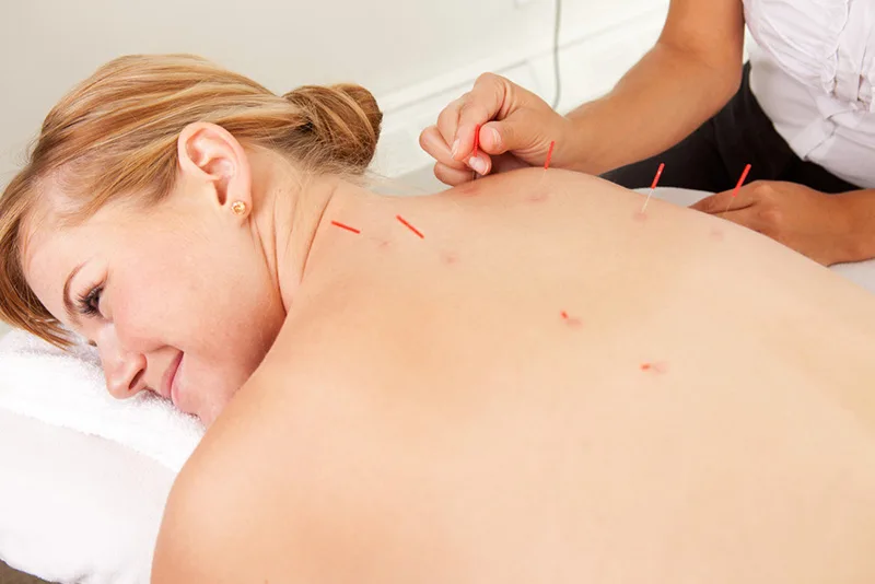 Acupuncture on back